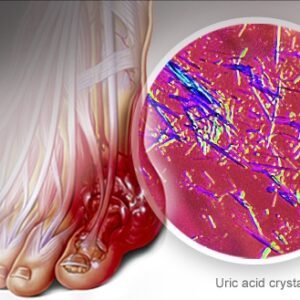 Uric Acid